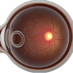 Posterior vitreous detachment