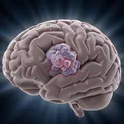 Brain Tumours