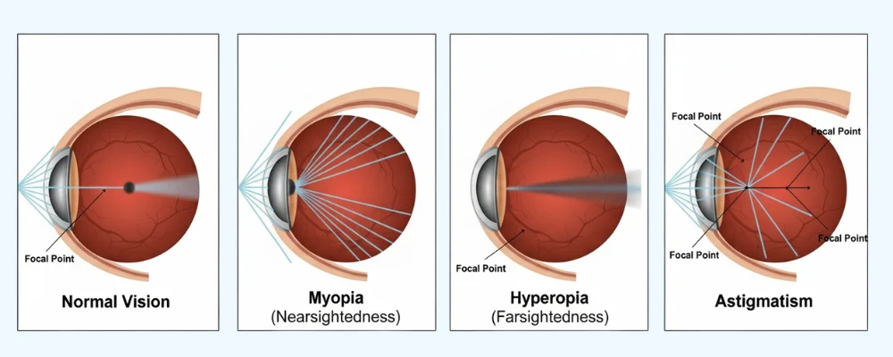 Conditions LASIK surgery helps correct